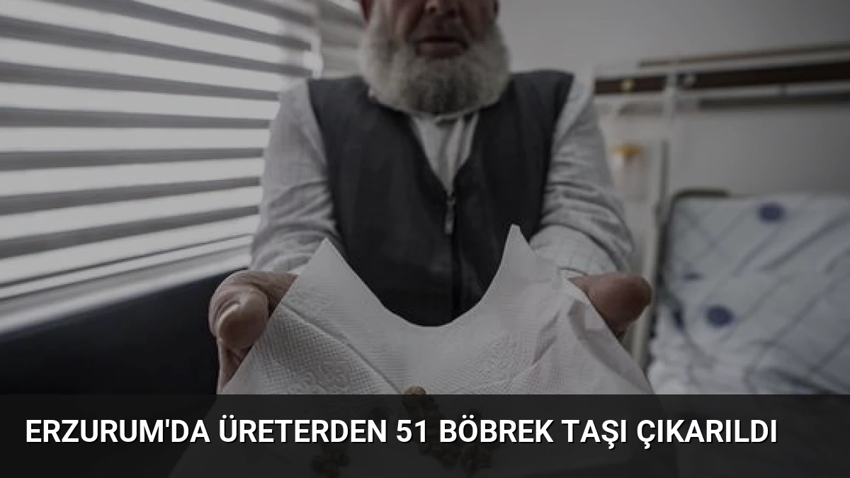 Erzurum’da Üreterden 51 Böbrek Taşı Çıkarıldı