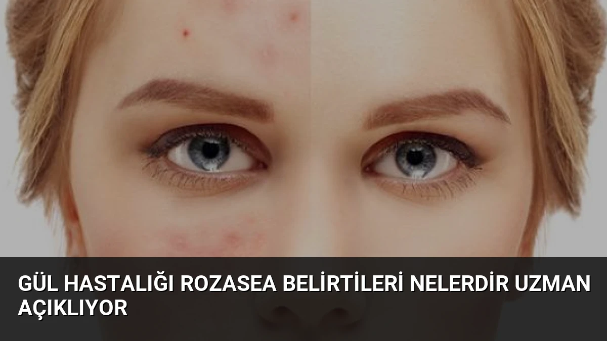 Gül Hastalığı Rozasea Belirtileri Nelerdir Uzman Açıklıyor