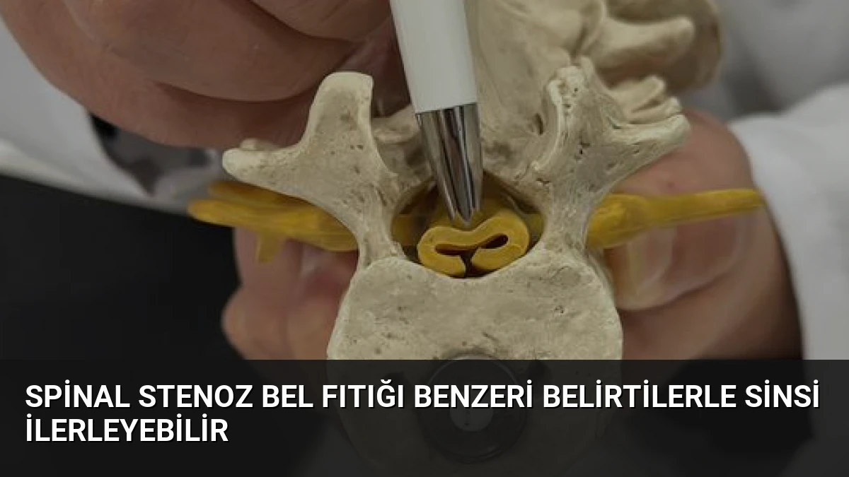 Spinal Stenoz Bel Fıtığı Benzeri Belirtilerle Sinsi İlerleyebilir