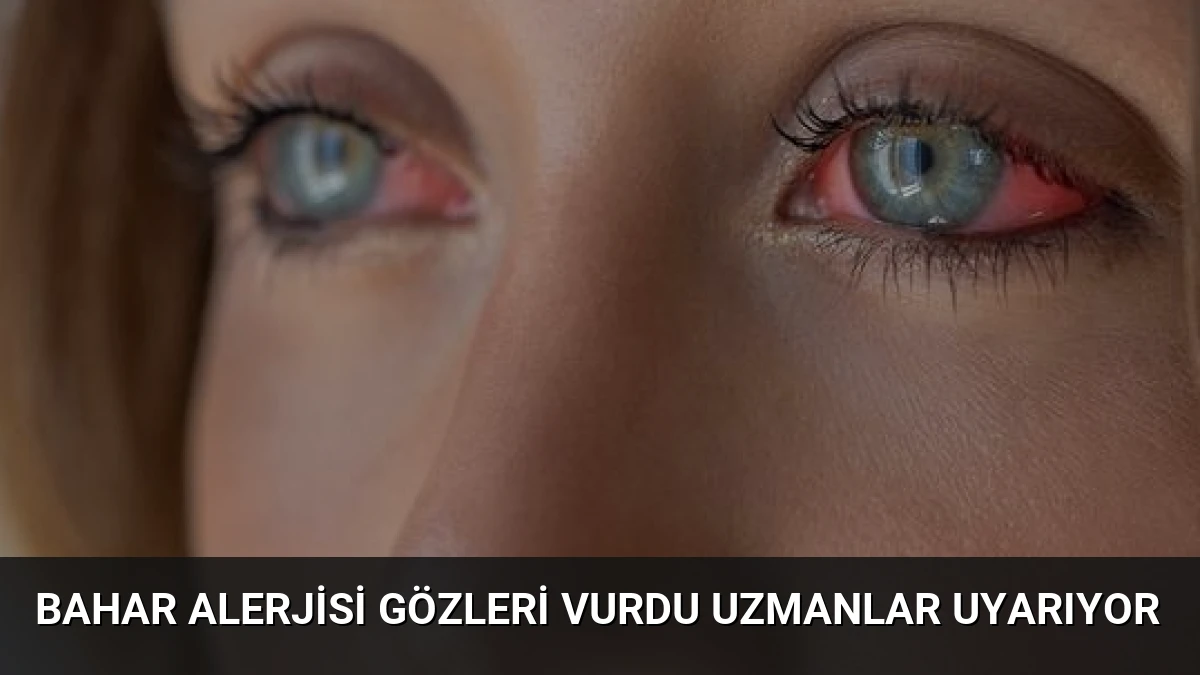 Bahar Alerjisi Gözleri Vurdu Uzmanlar Uyarıyor