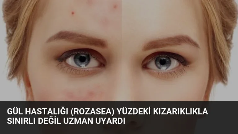Gül Hastalığı (Rozasea) Yüzdeki Kızarıklıkla Sınırlı Değil Uzman Uyardı