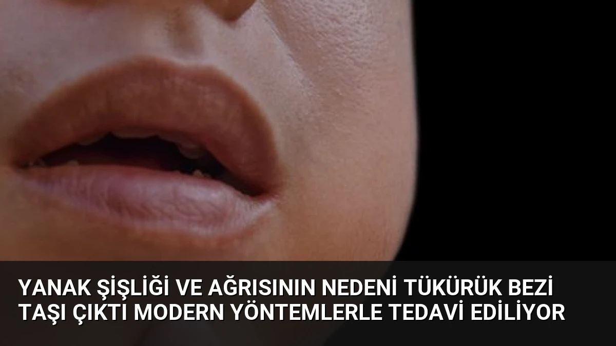 Yanak Şişliği ve Ağrısının Nedeni Tükürük Bezi Taşı Çıktı Modern Yöntemlerle Tedavi Ediliyor